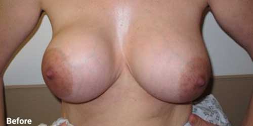 breast implant removal surgery before and after 
