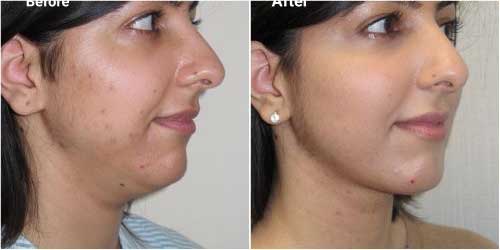 Vaser Chin Liposuction surgery before and after