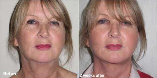 Faclelift surgery before and after 2 week recovery 