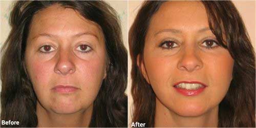 Mini face lift surgery before and after photographs 