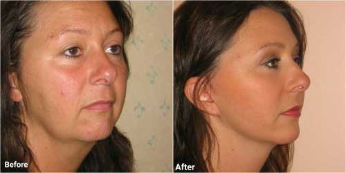 Mini face lift surgery before and after photographs
