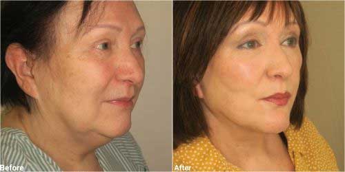 Necklift surgury with chin implant before and after 