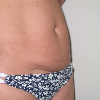 Side view of patient prior to Abdominoplasty surgery