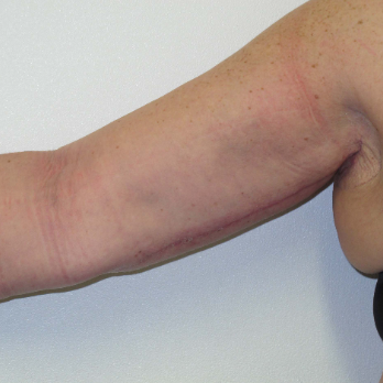 Front view of female patient after Brachioplasty Arm Lift surgery