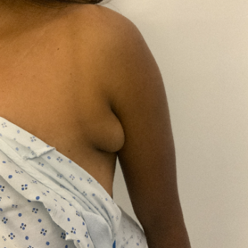 before-axillary-breast-removal