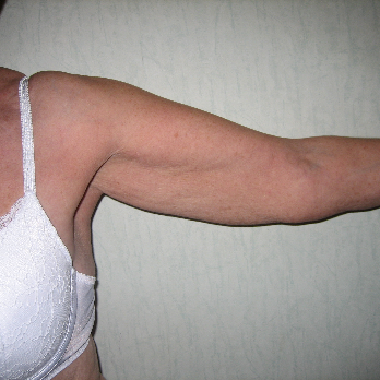 Front view of patient prior to Brachioplasty Arm Lift surgery