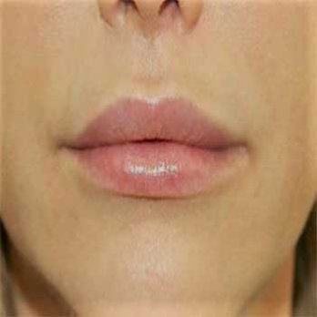 Front view of female patient after lip lift surgery