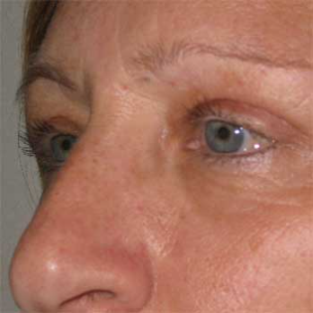 Side view of female patient after eyelid surgery