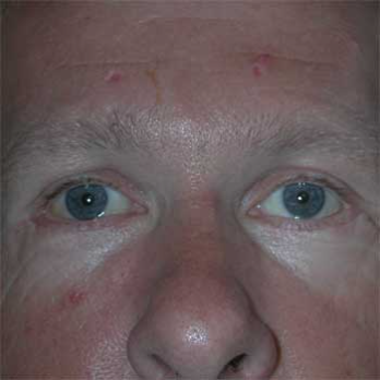 Front view of male patient prior to browlift surgery