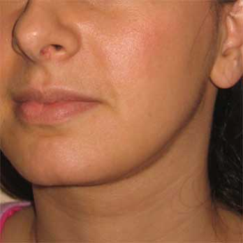 Quarter view of 22 year old after chin liposuction surgery
