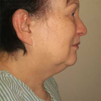Front view of female patient prior to necklift, submental lipo and chin implant