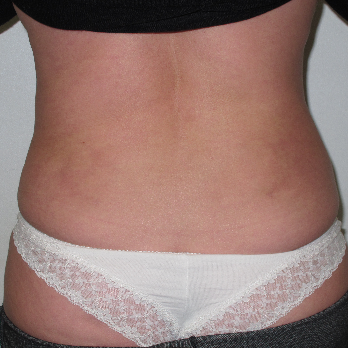 Back view of patient after VASER Liposelection surgery