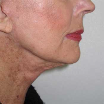 Side view of female patient after neck lift and lower facelift surgery