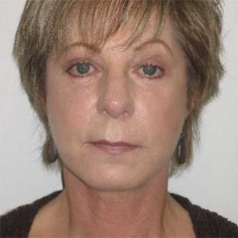 Front view of female patient after Facelift surgery