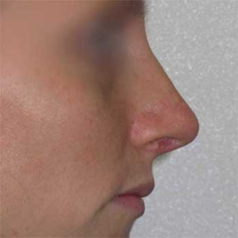 Side profile after rhinoplasty surgery