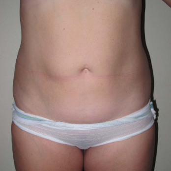 Back view of patient prior to VASER Liposelection surgery