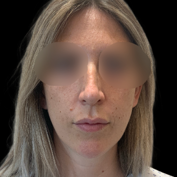 preservation-rhinoplasty-before