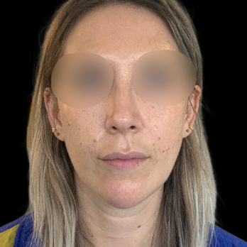 preservation-rhinoplasty-after