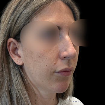 preservation-rhinoplasty-before