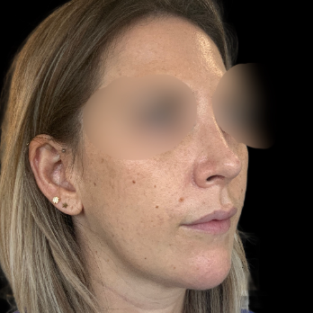 preservation-rhinoplasty-after