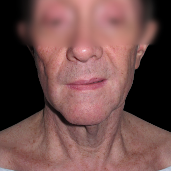 male-facelift-before