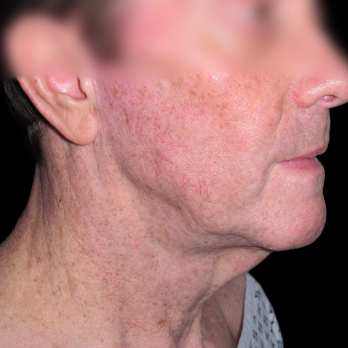 male-facelift-before