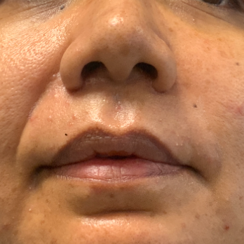 before-and-after-nostril-reduction