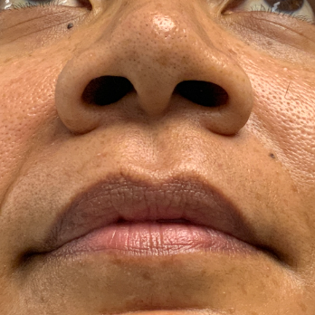 before-and-after-nostril-reduction