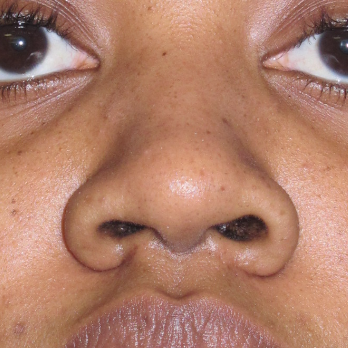 before-and-after-nostril-reduction