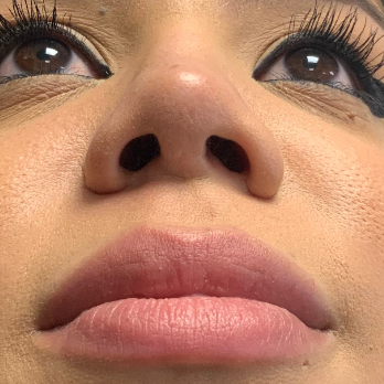 before-and-after-nostril-reduction