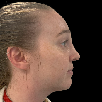 Ultrasonic-rhinoplasty-after