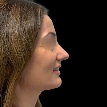 ultrasonic-rhinoplasty-after